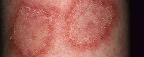 Homeopathy Doctor for Skin Treatment in Mumbai